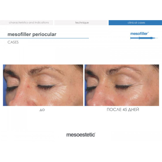 Мезофілер Періокулар 15 мг/мл Mesoestetic Мesofiller periocular 15 mg/ml шприц 1мл