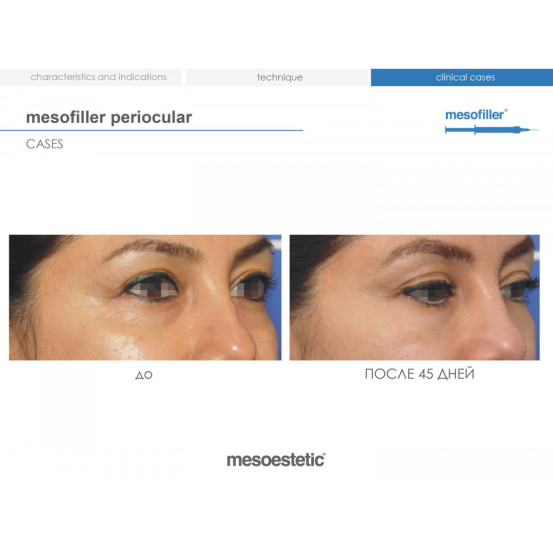 Мезофілер Періокулар 15 мг/мл Mesoestetic Мesofiller periocular 15 mg/ml шприц 1мл