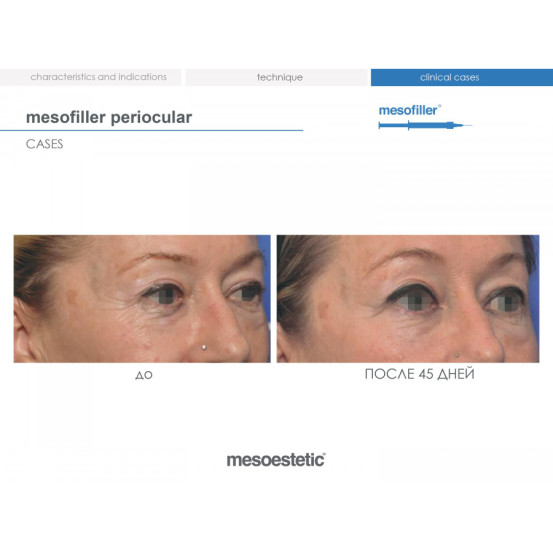 Мезофілер Періокулар 15 мг/мл Mesoestetic Мesofiller periocular 15 mg/ml шприц 1мл