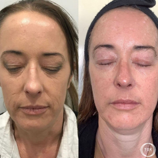 Профессиональный депигментирующий набор Mesoestetic "Дермамелан" Dermamelan pack NEW