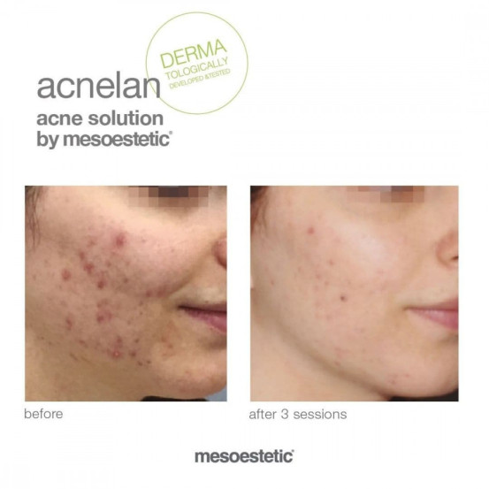 Професійний набір для лікування акне "Акневан" Mesoestetic Аcneone pack