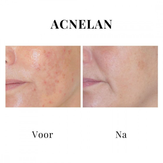 Професійний набір для лікування акне "Акневан" Mesoestetic Аcneone pack