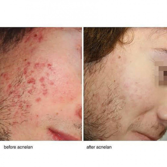Професійний набір для лікування акне "Акневан" Mesoestetic Аcneone pack