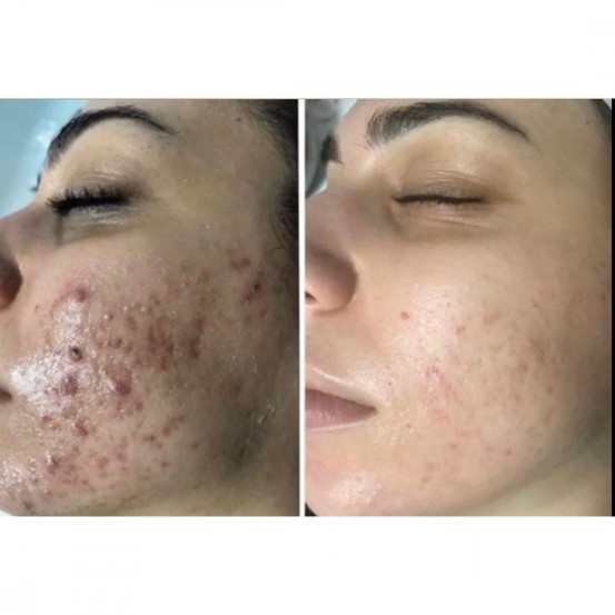 Професійний набір для лікування акне "Акневан" Mesoestetic Аcneone pack