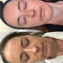 Профессиональный депигментирующий набор Mesoestetic "Дермамелан" Dermamelan pack NEW