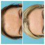 Профессиональный депигментирующий набор Mesoestetic "Дермамелан" Dermamelan pack NEW